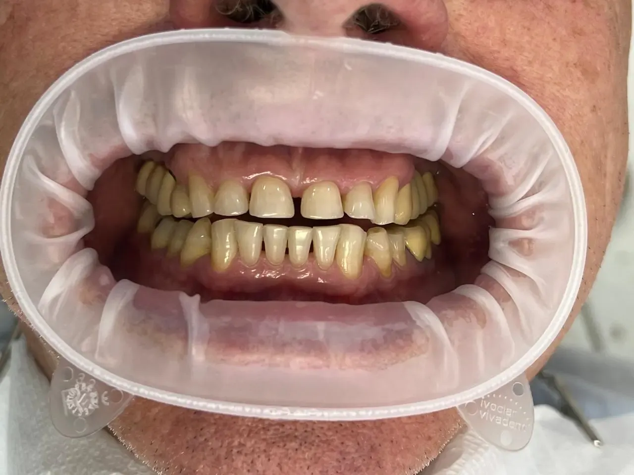 Antes do tratamento com lentes de contato dental
