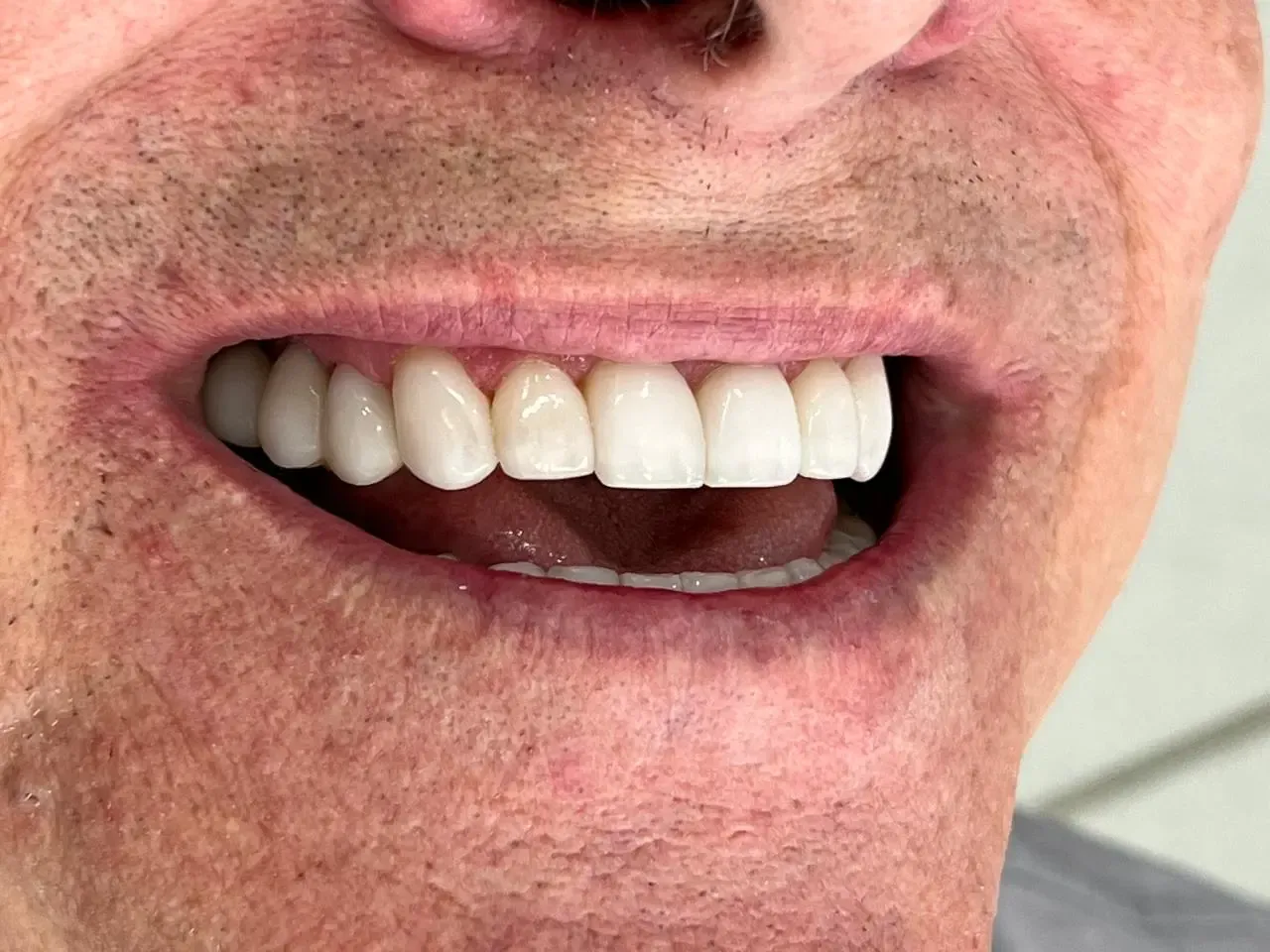Depois do tratamento com lentes de contato dental