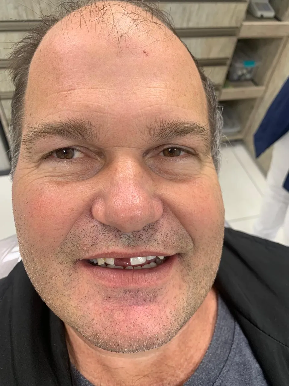 Antes da reabilitação com prótese dentária