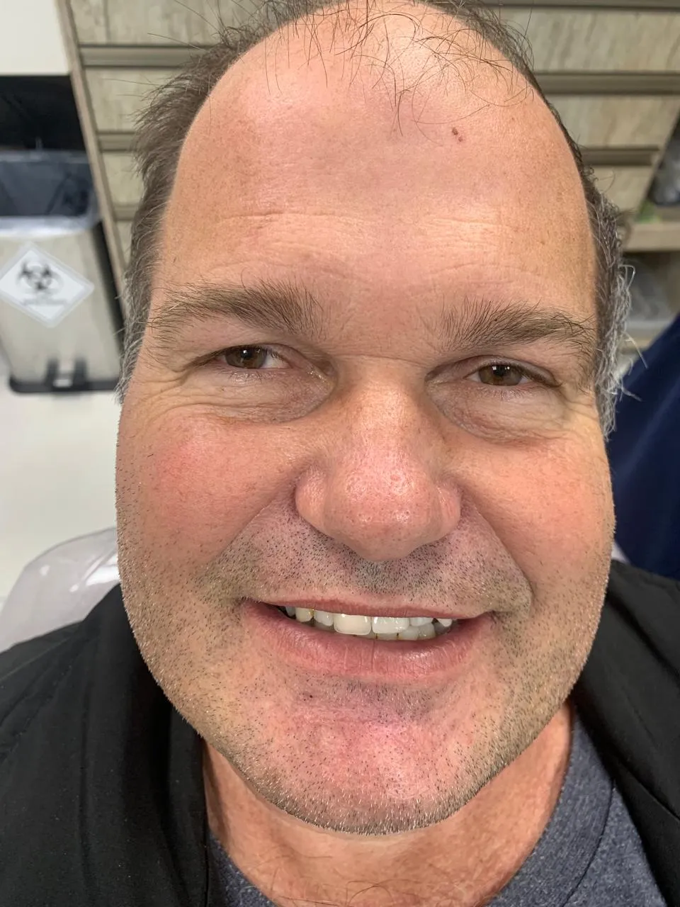 Depois da reabilitação com prótese dentária